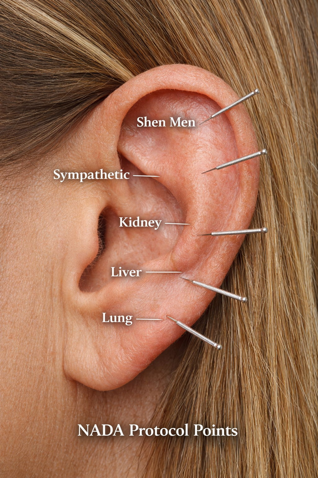 A human ear with five acupuncture needles inserted at various points labeled Shen Men, sympathetic, kidney, liver, and lung, with a text overlay that reads 'NADA Protocol Points'.