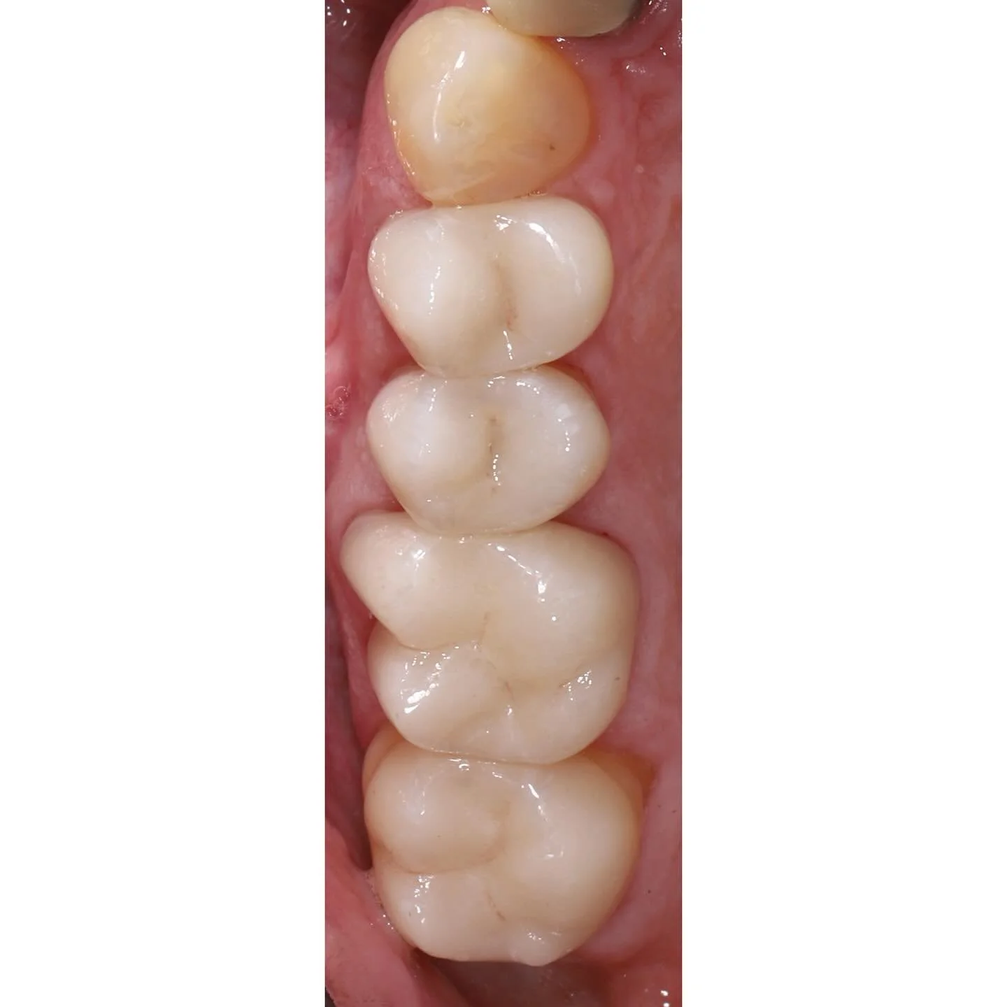 Quad of dentistry. Same steps every time. 

Great work as always from @synergy_dental_ 

#dovernh #seacoastnh #dentist #dentistry