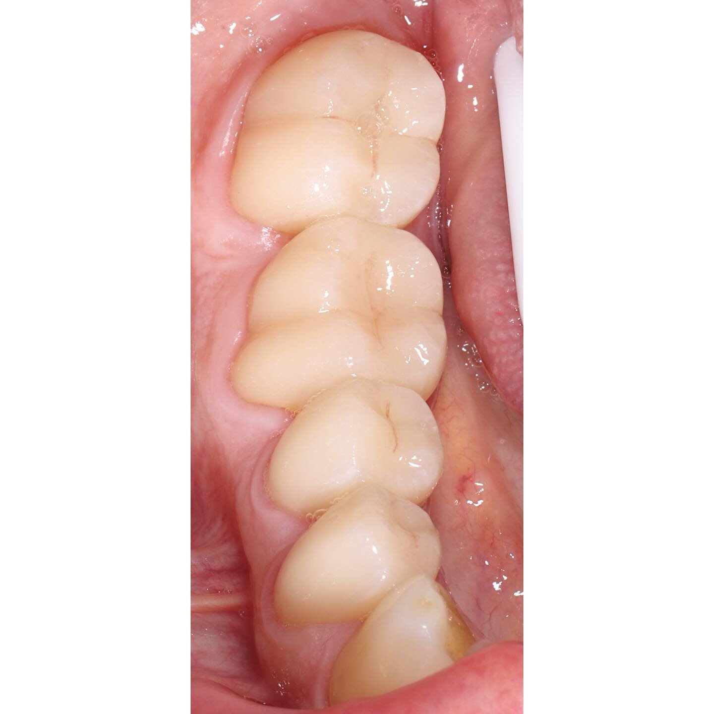 Quad of dentistry. Same process every time. 

@synergy_dental_ 

#dentistry #dovernh #seacoastnh #dental #dentalphotography