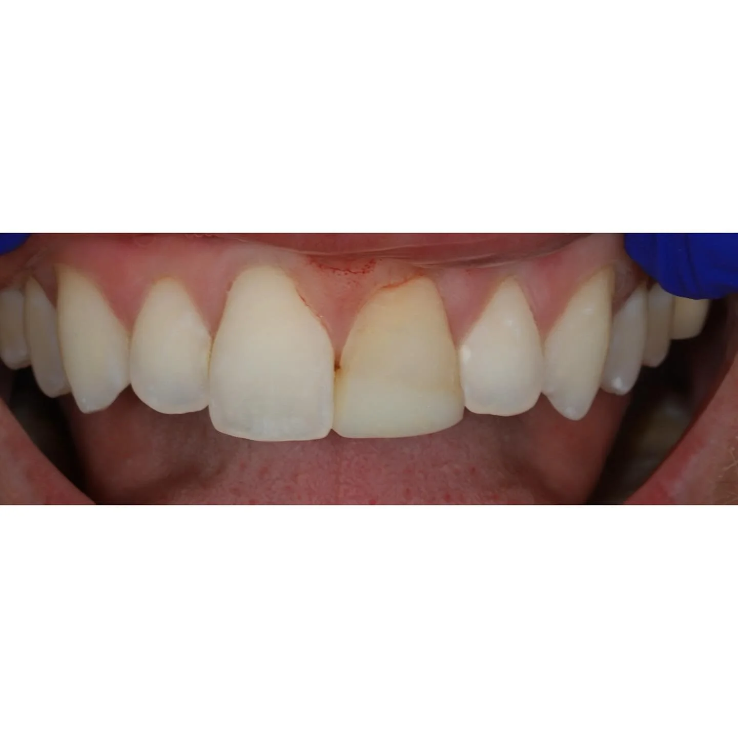 I guess I can&rsquo;t make fun of his front tooth anymore 

@synergy_dental_ 

#dovernh #seacoastnh #aacd #dentist #dentistry #crown