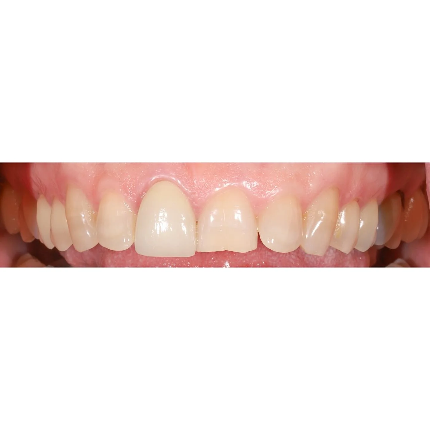 Tissue health is key. Acid destroys teeth. 

Before➡️After

#dovernh #seacoastnh #dentistry #dental