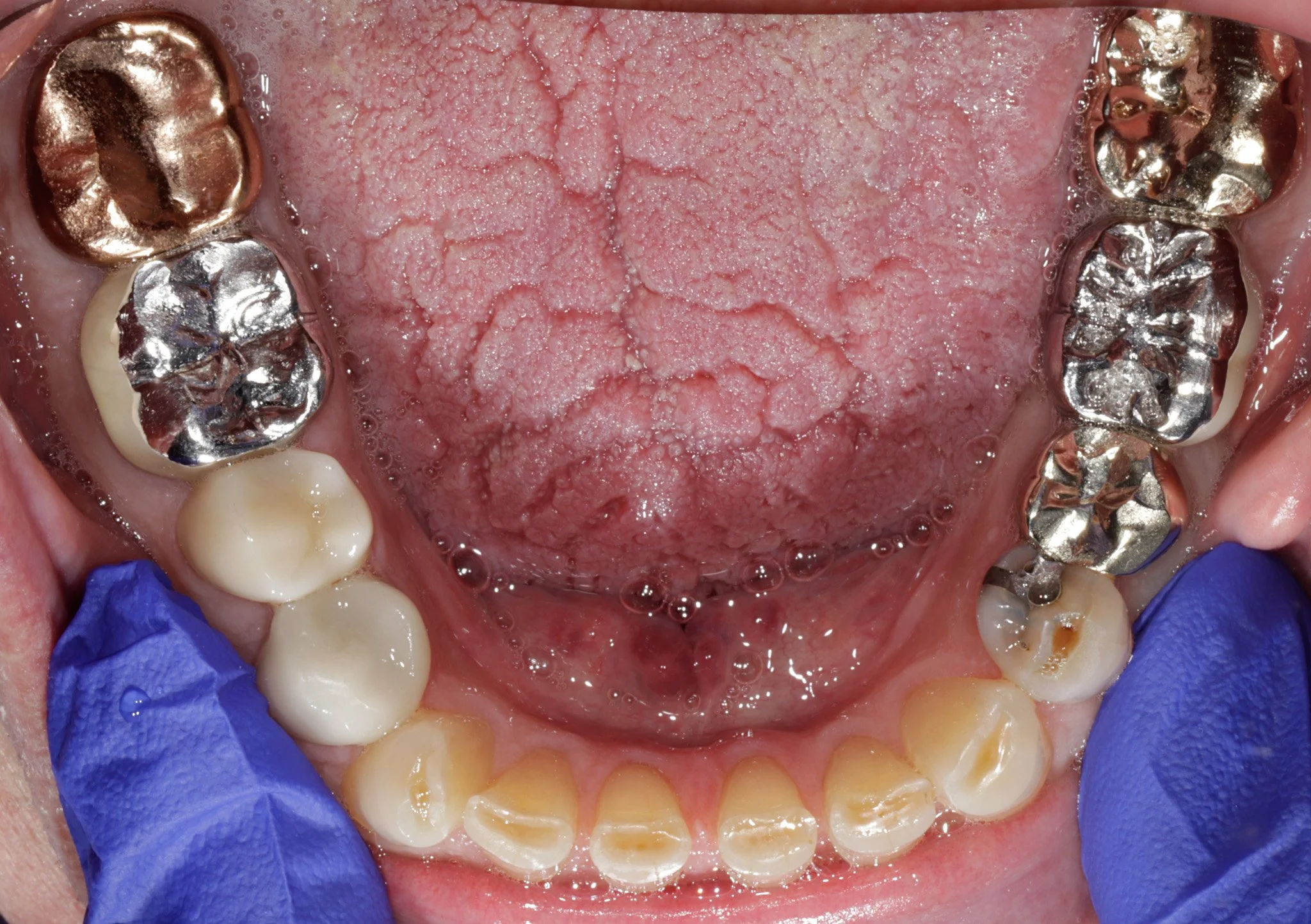 A patient's teeth with old, failing dentistry. Prior to restoring.