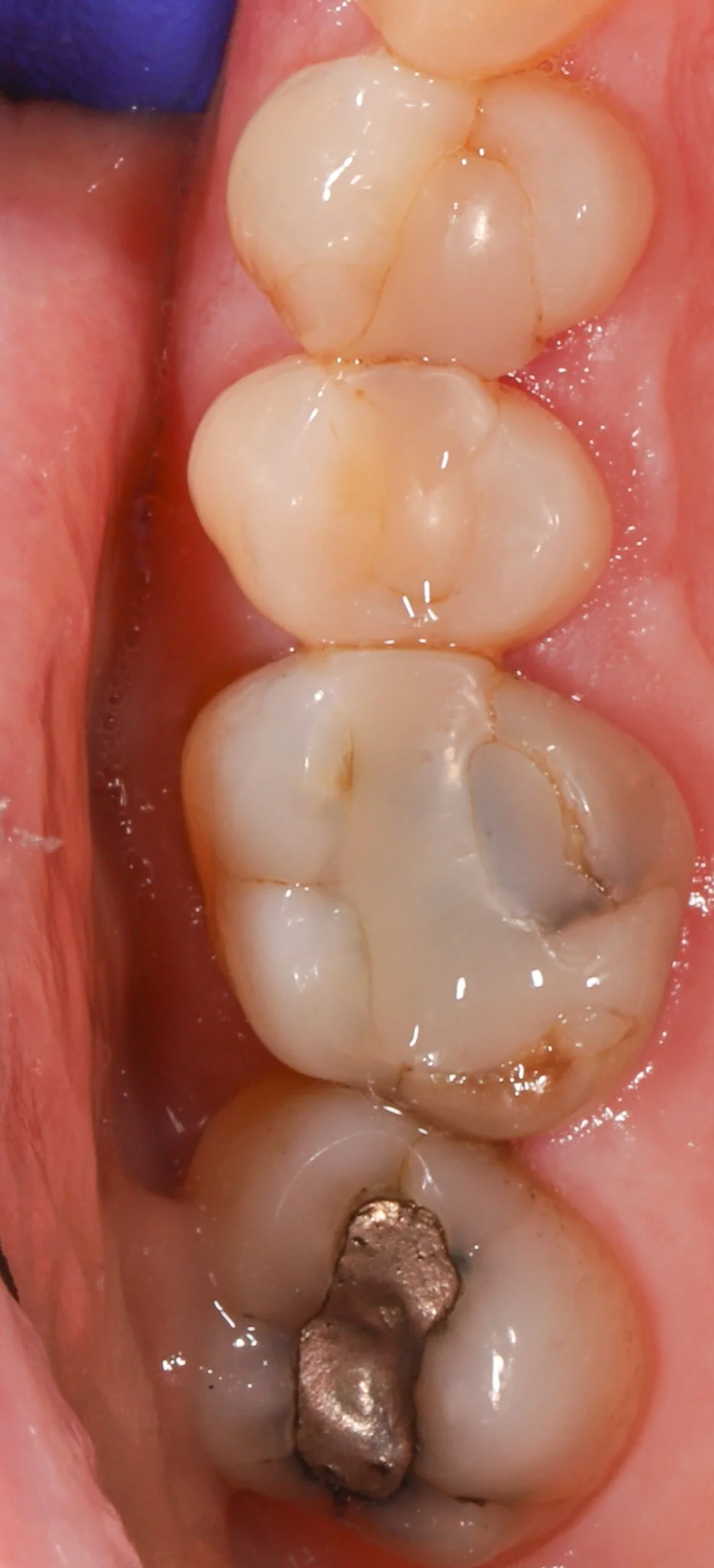 Close-up image of the upper molars in a person's mouth, with visible dental restorations, including a metal filling on the molar furthest back on the right and signs of dental wear or decay on the other teeth.