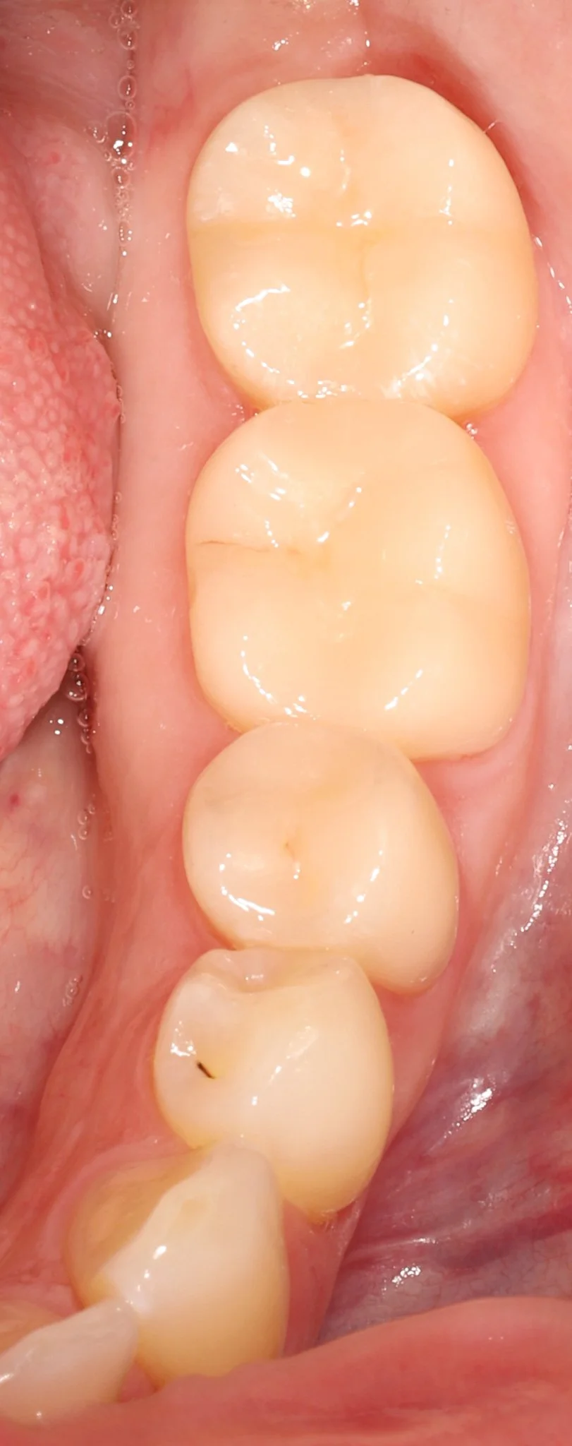 Close-up of molar teeth after restorations with bonded porcelain crowns showing optimal dental health.