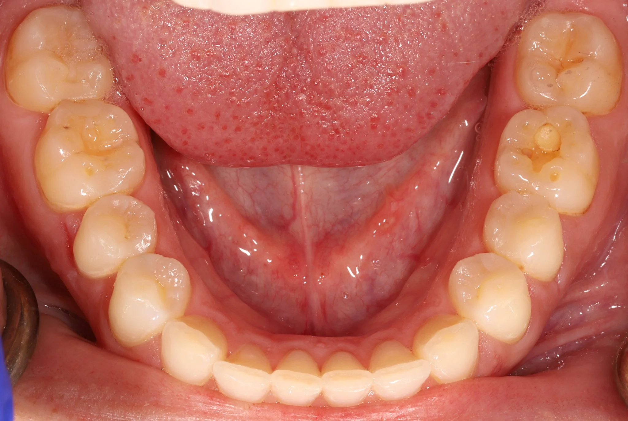 Close-up of the lower teeth showing decay and acid erosion.  Prior to restorative treatment.