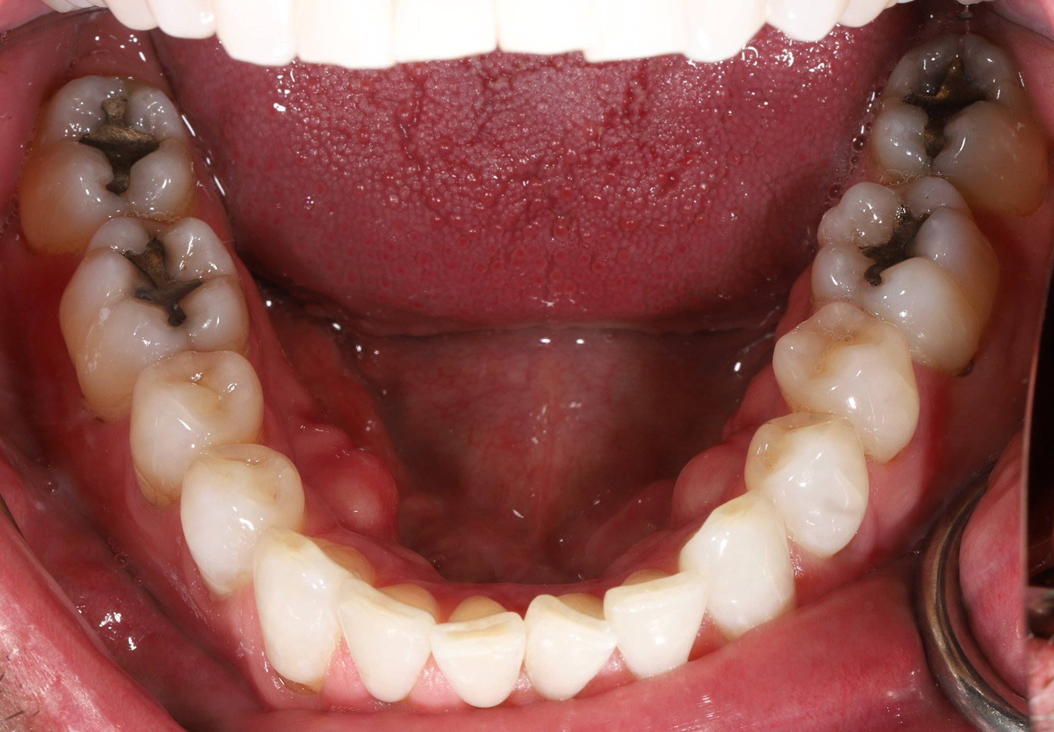 Open mouth displaying upper and lower molars with multiple cavities and decay.