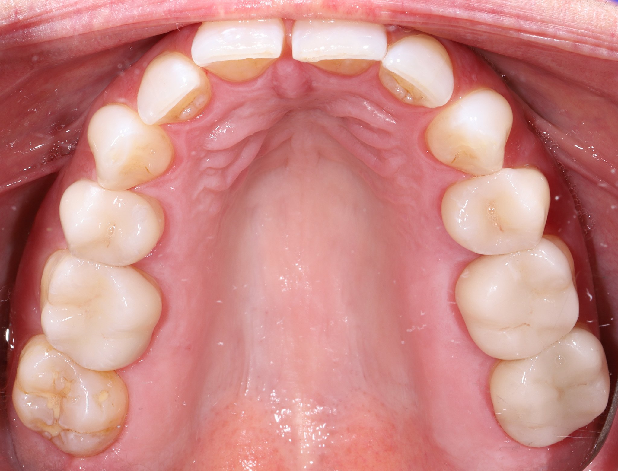 Close-up of the upper teeth and roof of mouth, showing some dental decay on molars, in a person's mouth.