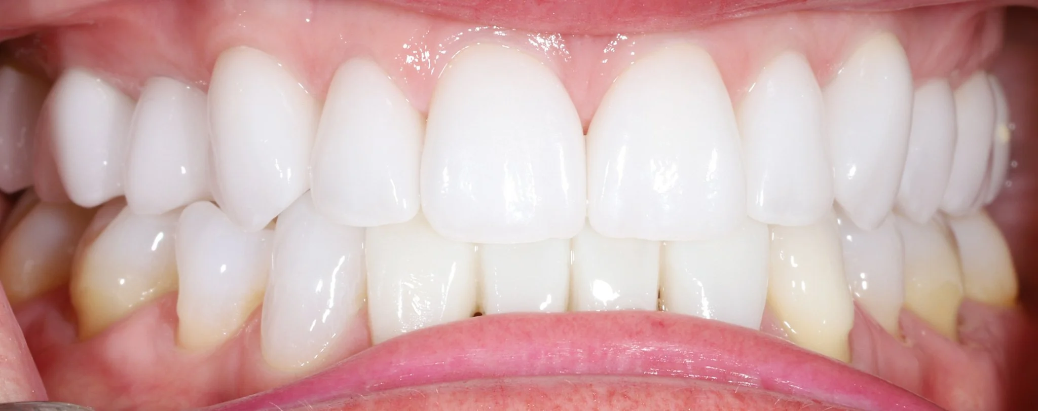 Close-up of a person's upper and lower teeth showing restored smile with proper aesthetics and tooth proportions.