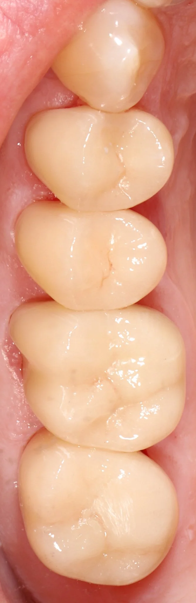 Close-up of four back molars in a person's mouth, showing clean, healthy, light-colored teeth.