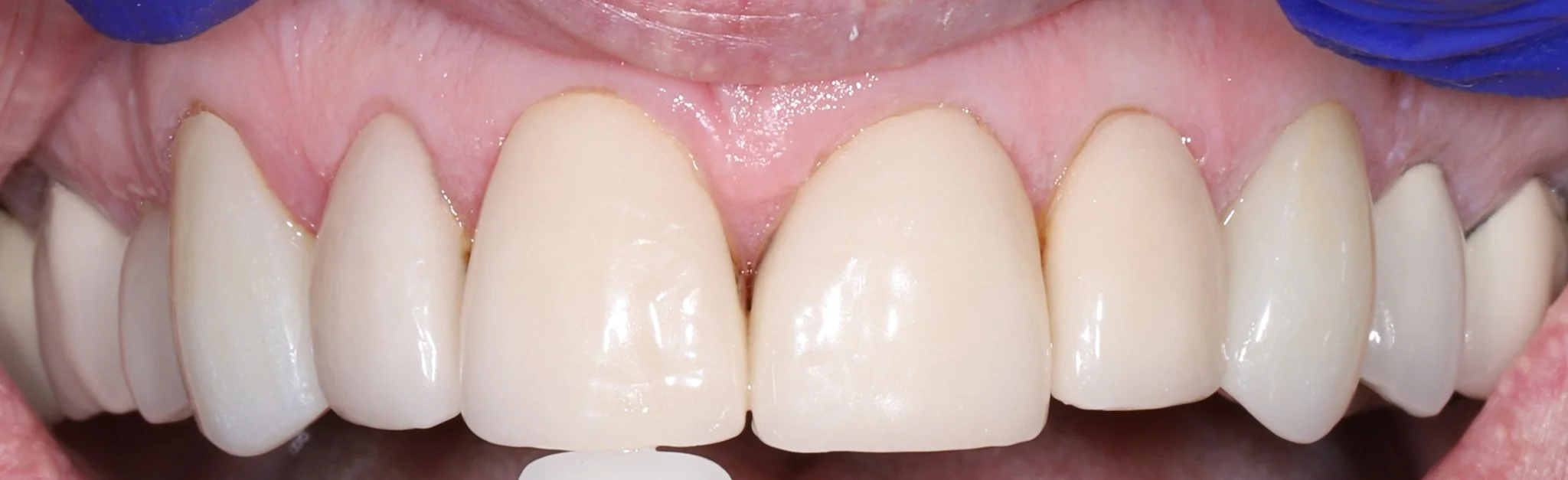 Close-up of a person's upper front teeth showing dental restorations or crowns on the central incisors and lateral incisors.