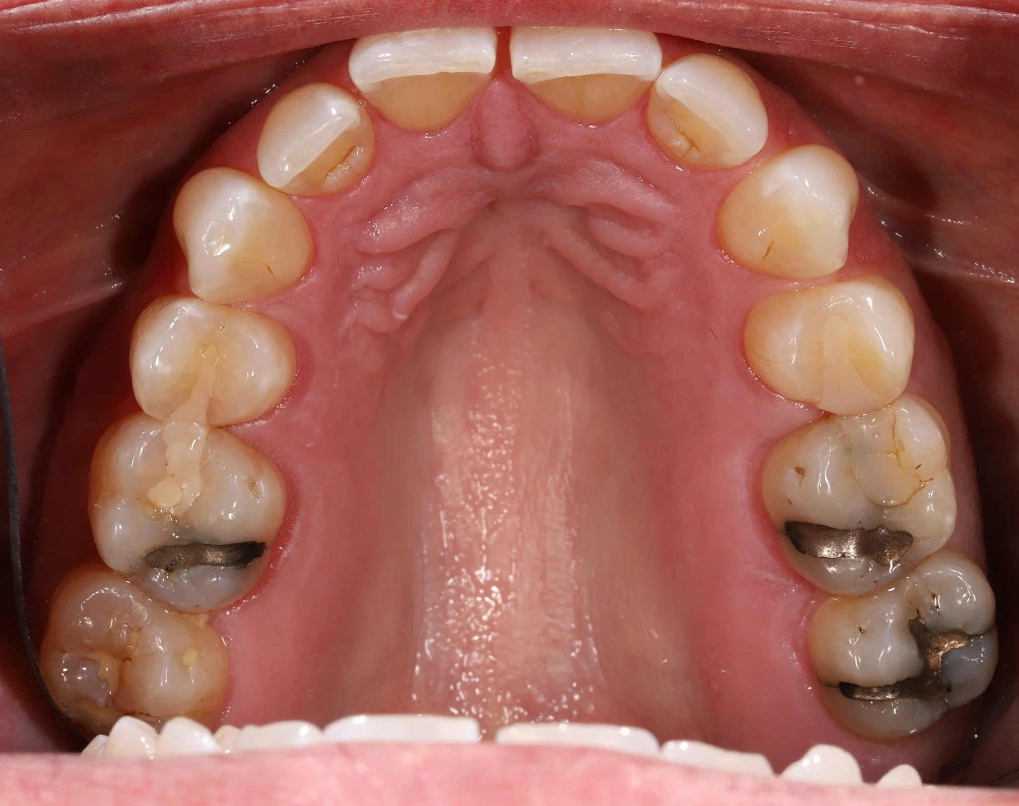 Inside of a person's mouth showing upper teeth, some with dental fillings, and healthy gums.