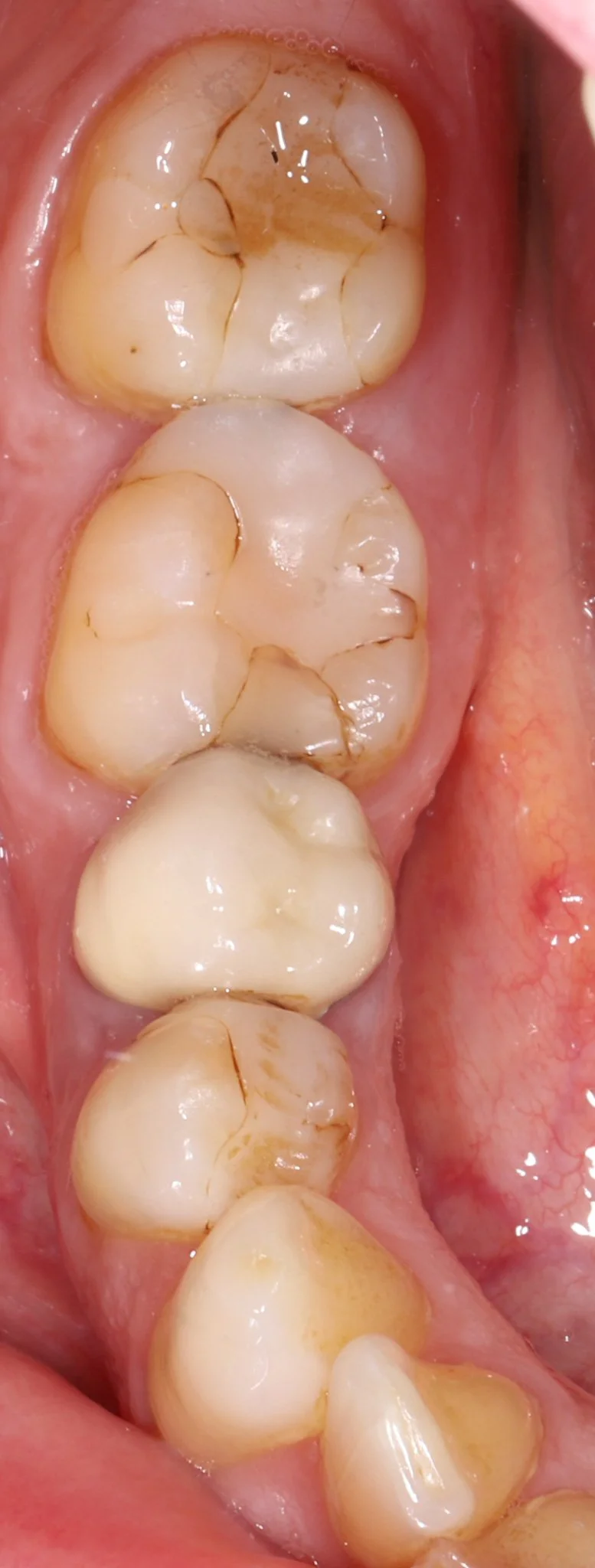 Close-up of human molars and premolars with visible signs of staining and early decay in the back teeth.