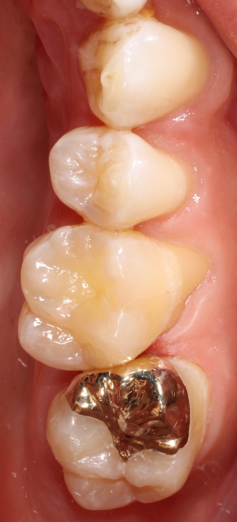 Close-up of human teeth, showing one tooth with a dark cavity and gold filling, and surrounding teeth with healthy enamel