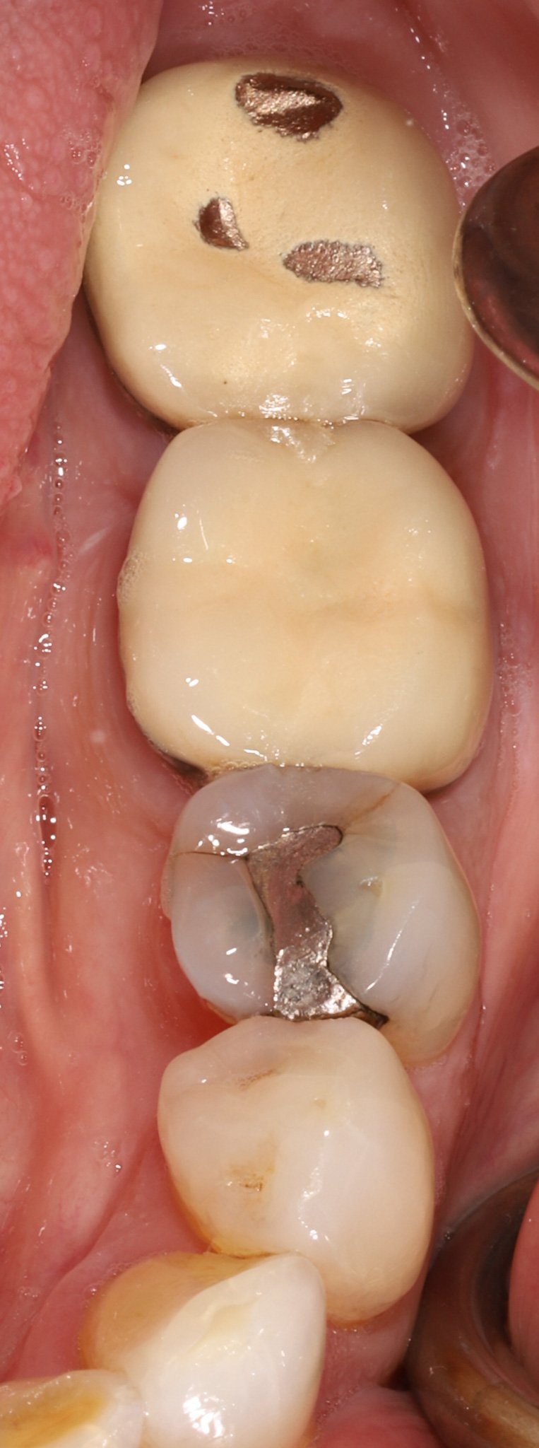 Close-up view of upper molars in a person's mouth showing dental fillings, decay and broken crowns.
