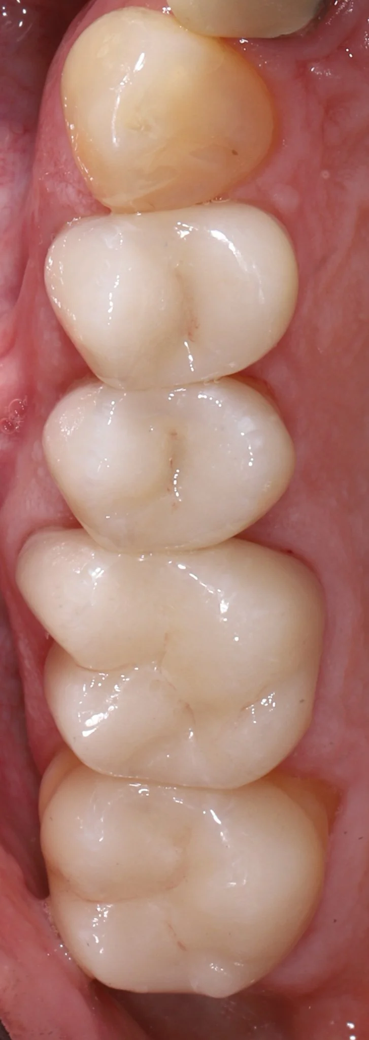 Close-up view of molar teeth in the lower jaw with visible gum tissue.
