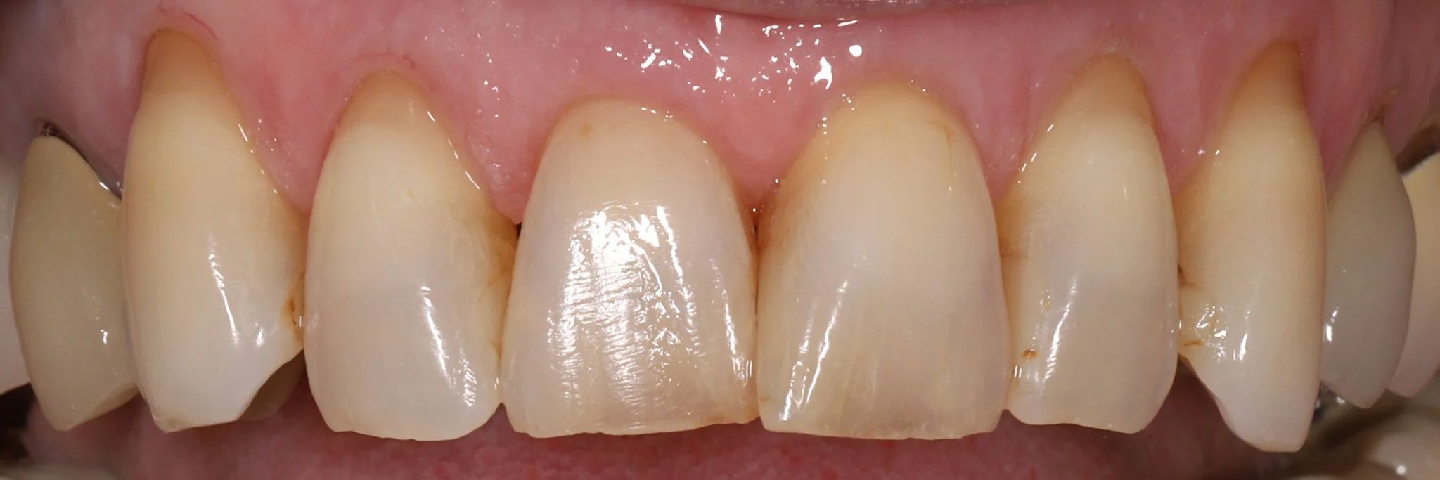 Close-up of misaligned upper front teeth with plaque and tartar buildup near the gum line.
