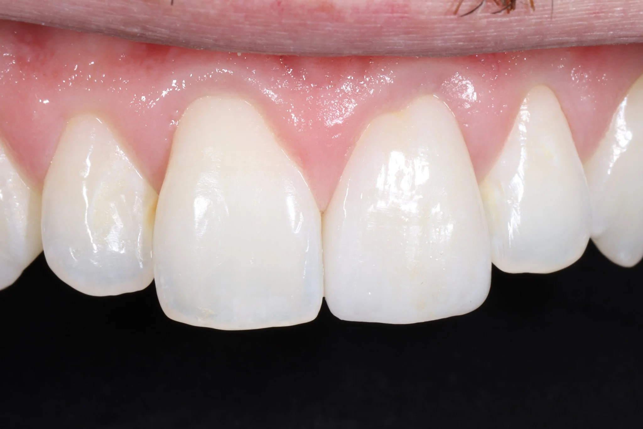 Close-up of upper front teeth and gums with natural appearance.