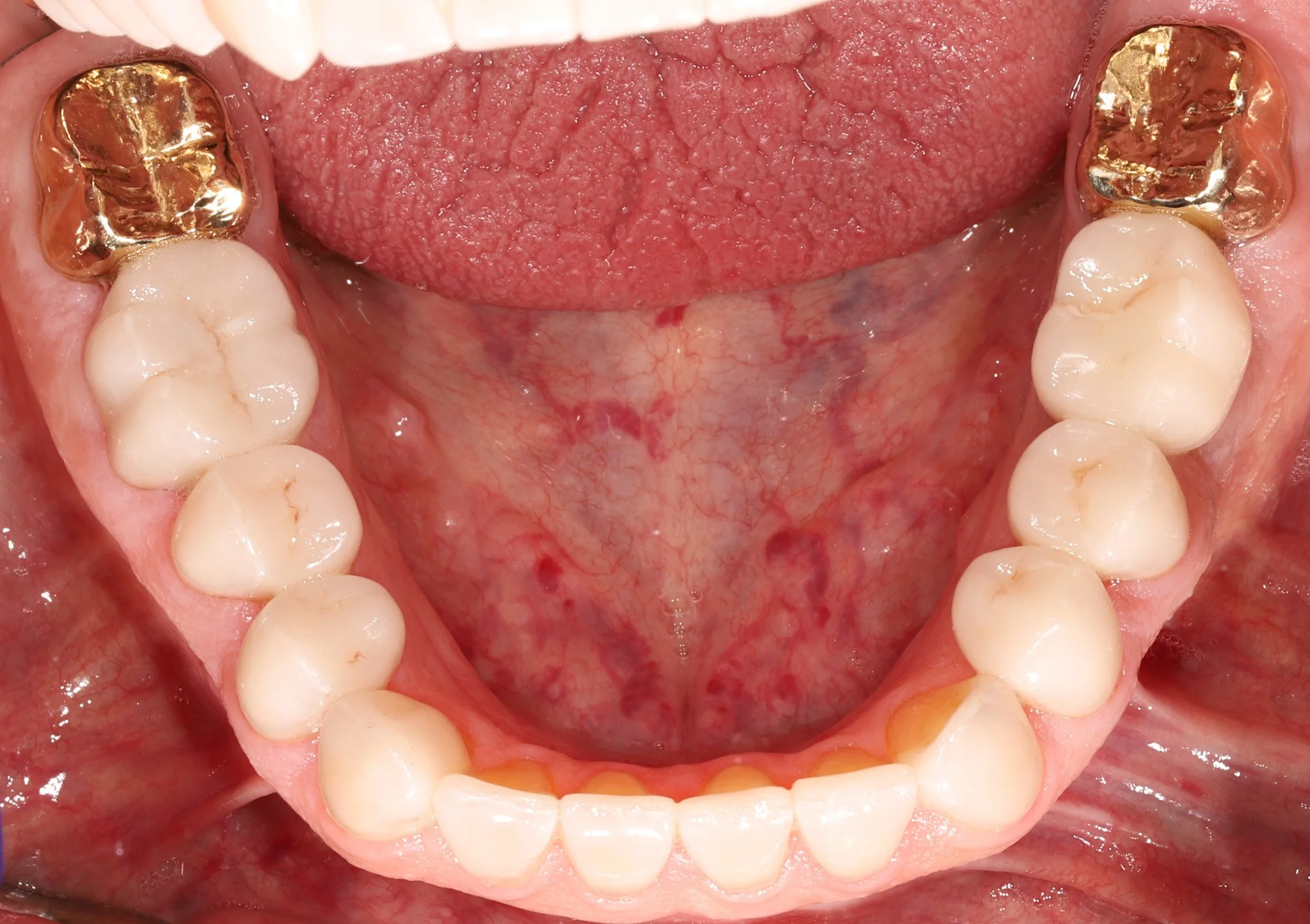 A patient's teeth after restoring with bonded porcelain and gold restorations.