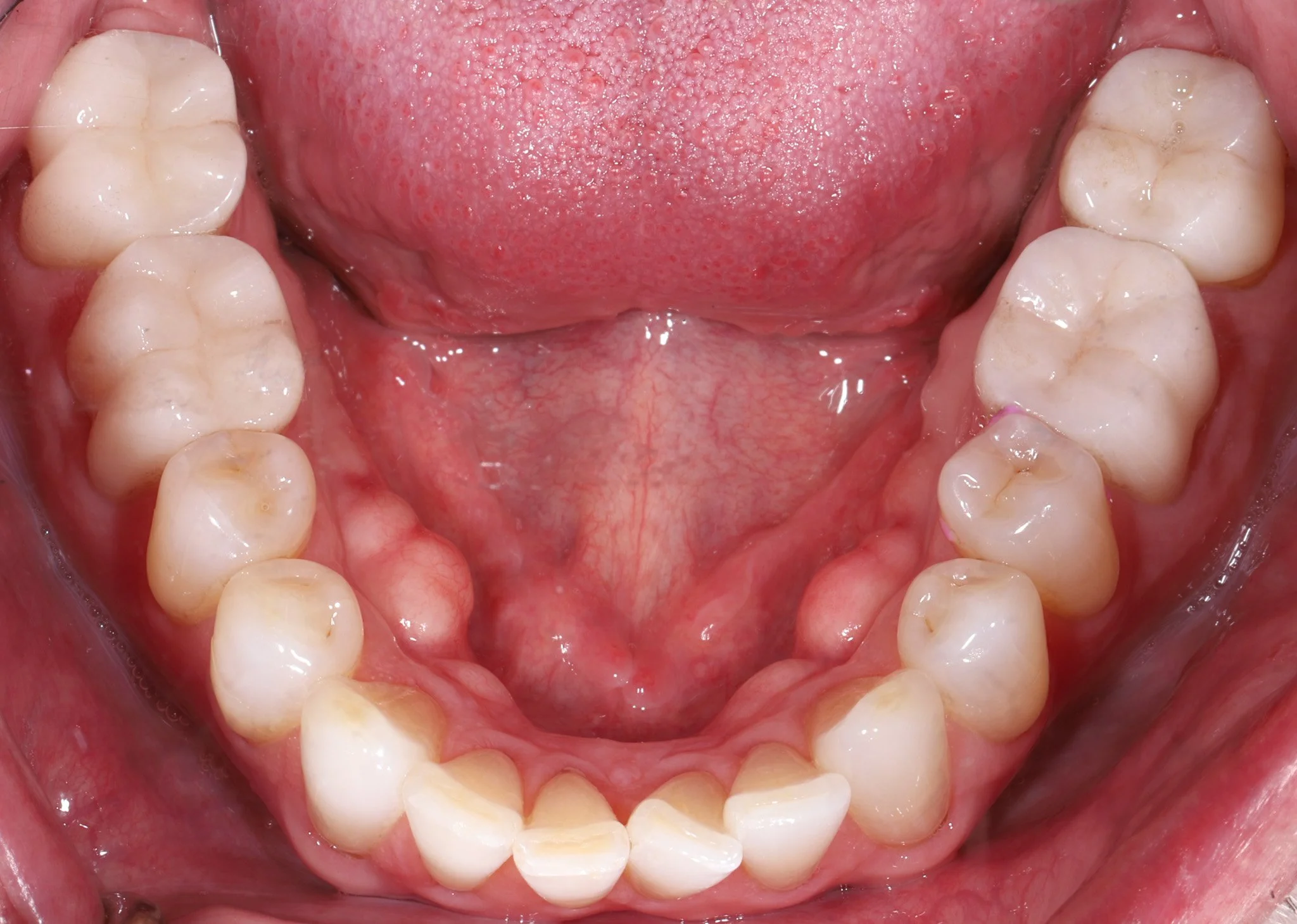 Open mouth showing upper and lower teeth with healthy gums and tongue