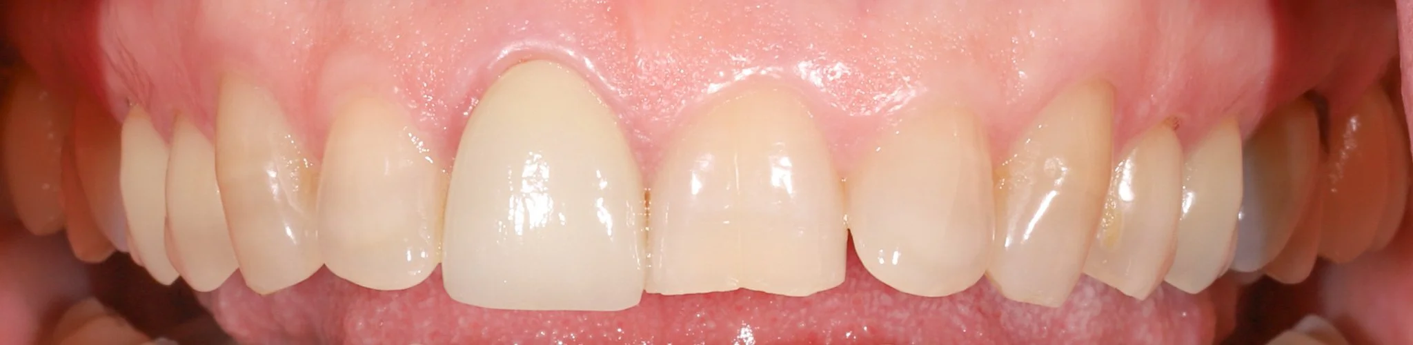 Close-up image of upper front teeth showing mismatched crowns, chipped and worn teeth with acid erosion.