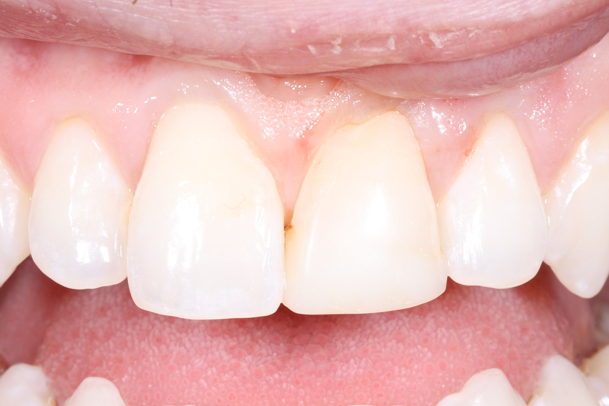 Close-up of a person's upper front teeth, showing slight misalignment and a small gap between the two front teeth.