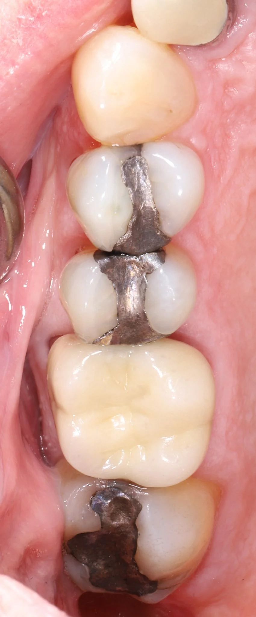 Close-up of human teeth with dental amalgam fillings in the molars.