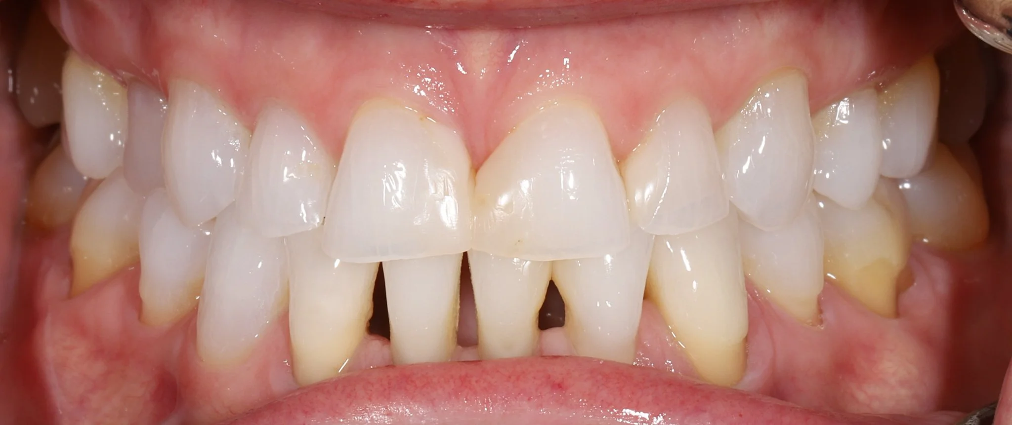 Close-up view of patient's teeth showing wear, acid erosion, misalignment and black triangles.