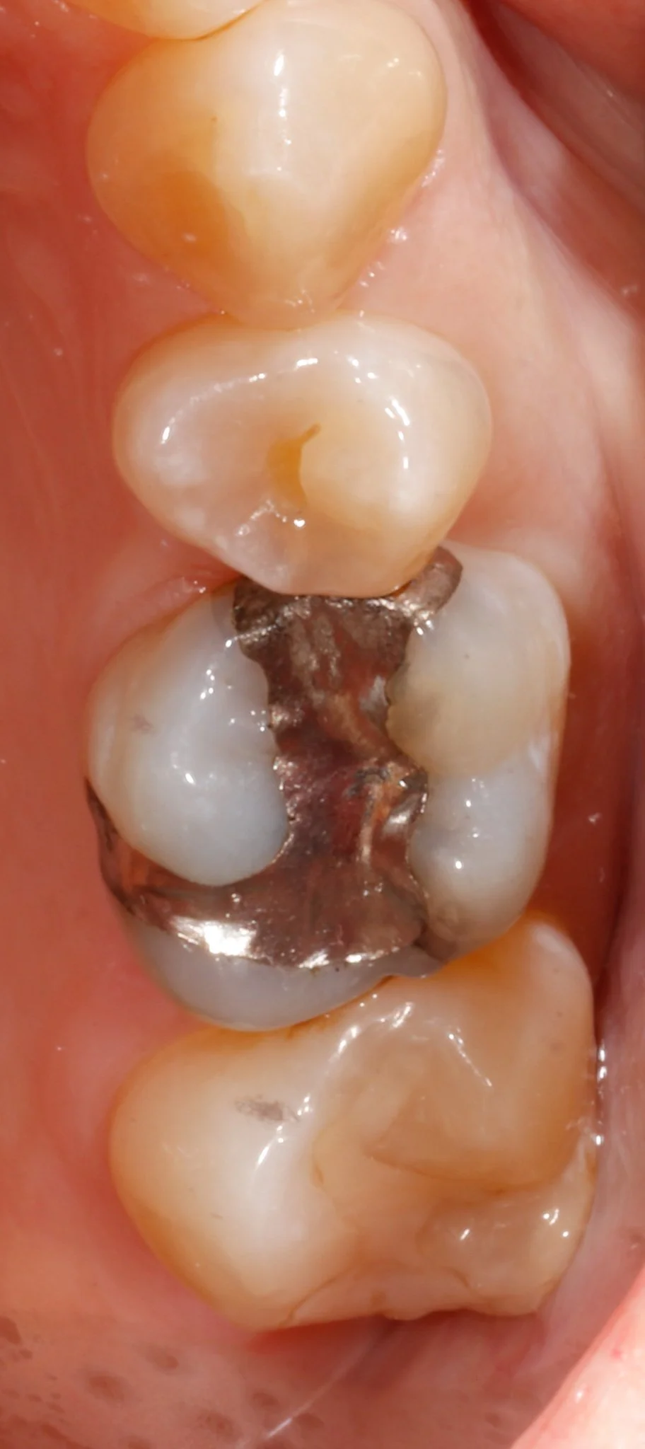 Close-up of a person's molar teeth with leakage, cracks and decay.  Prior to restorative treatment.