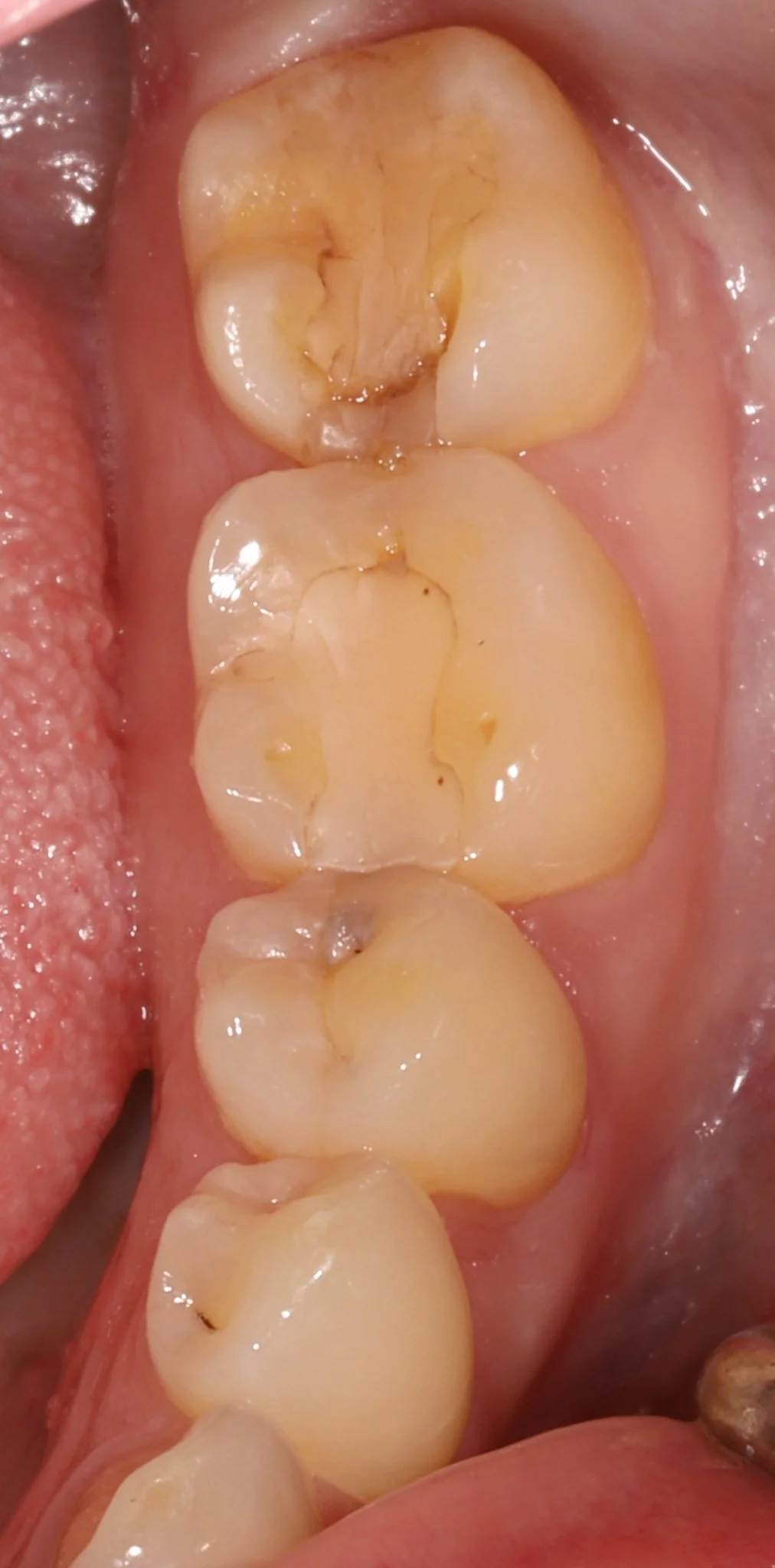 Close-up of molar teeth with signs of decay, leakage and cracks. Prior to restorative treatment.