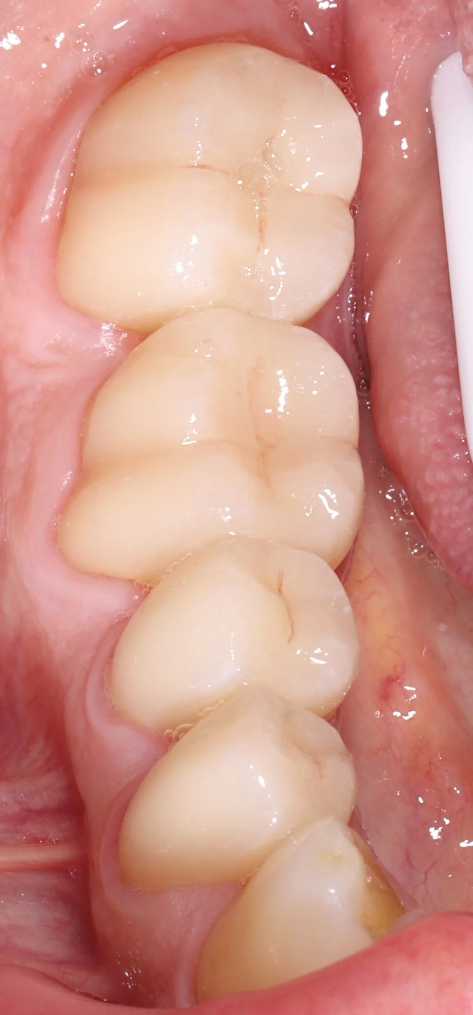 Close-up of four white molar teeth inside a person's mouth.