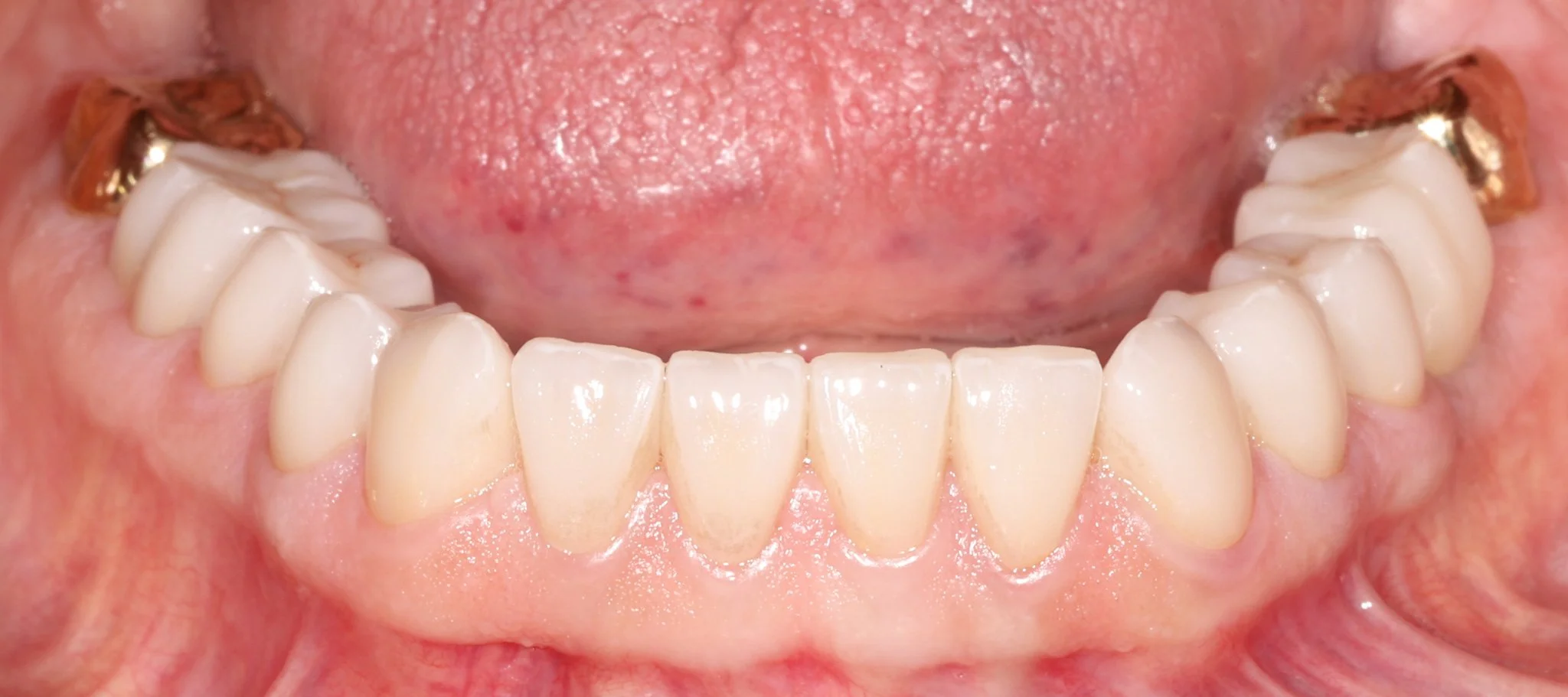 Teeth after restoring with bonded porcelain and gold, building back optimal aesthetics and function.