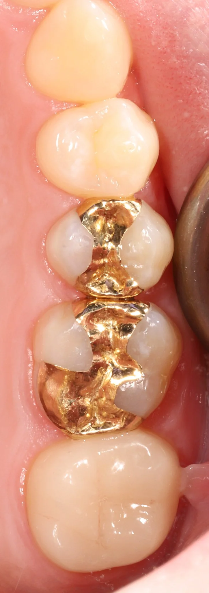Close-up of lower molars with gold dental crowns and fillings.