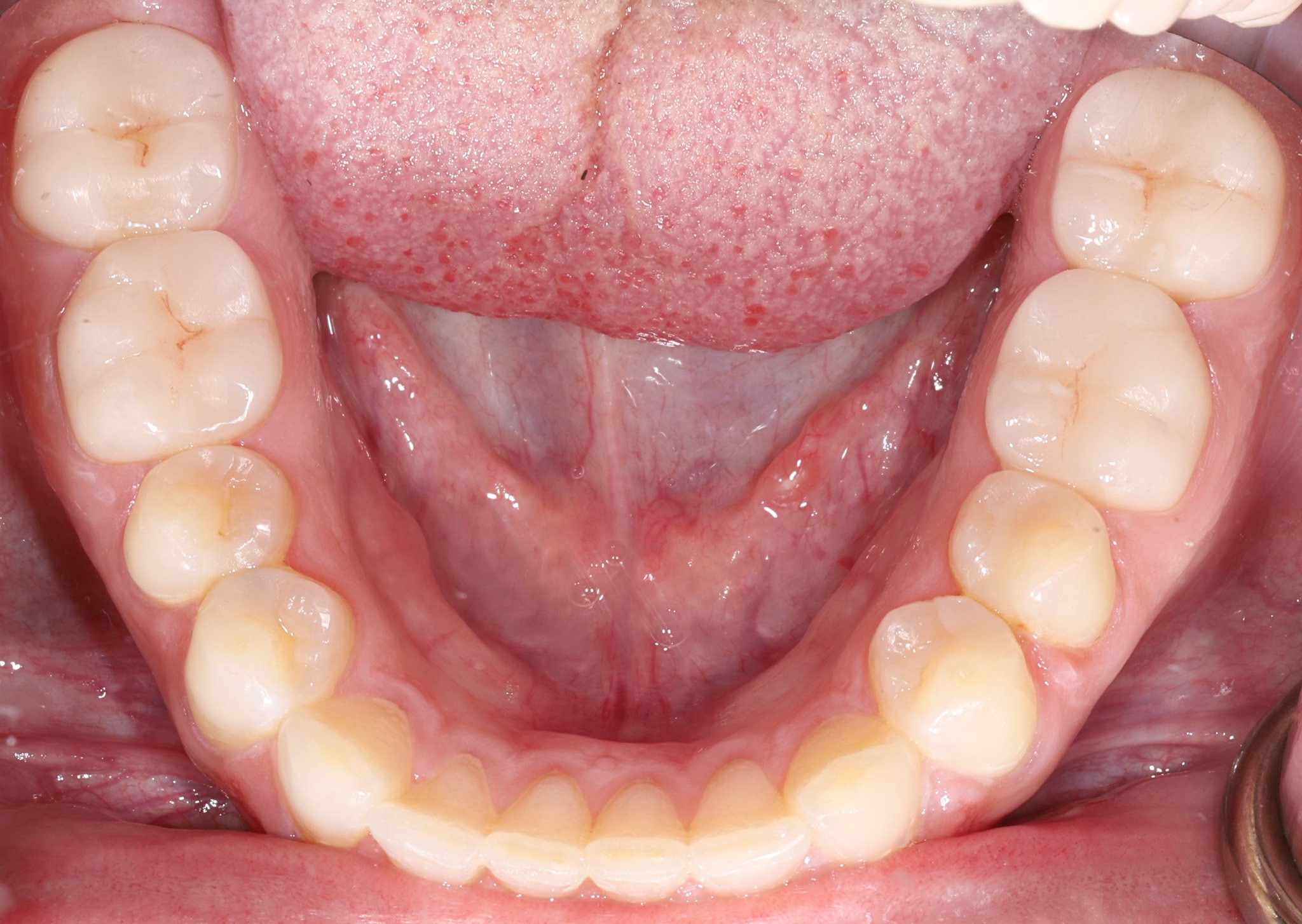 Close-up of the restored teeth with bonded porcelain crowns that fit and blend with natural dentition.