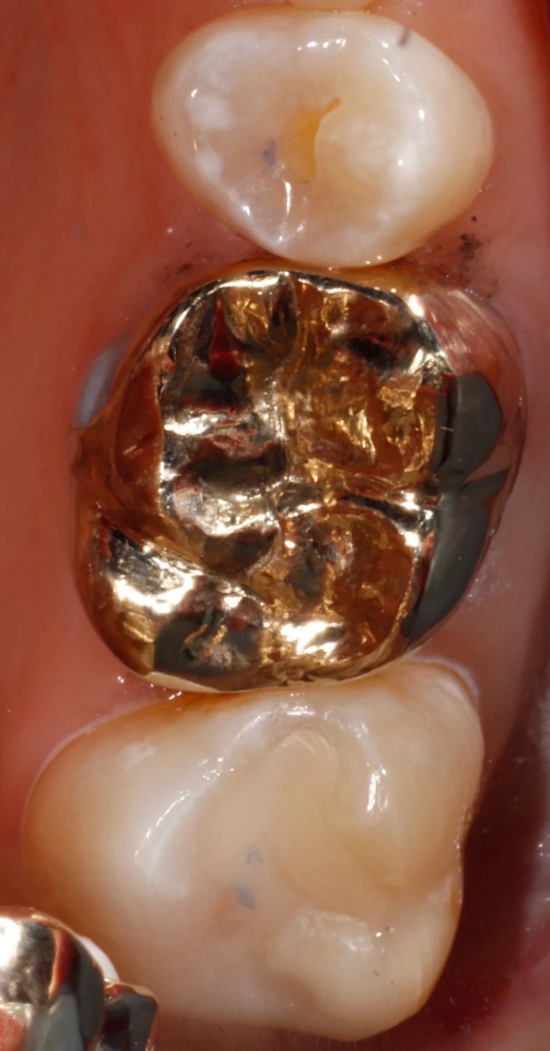 Close-up of a person's molar teeth restored with gold and composite resin.