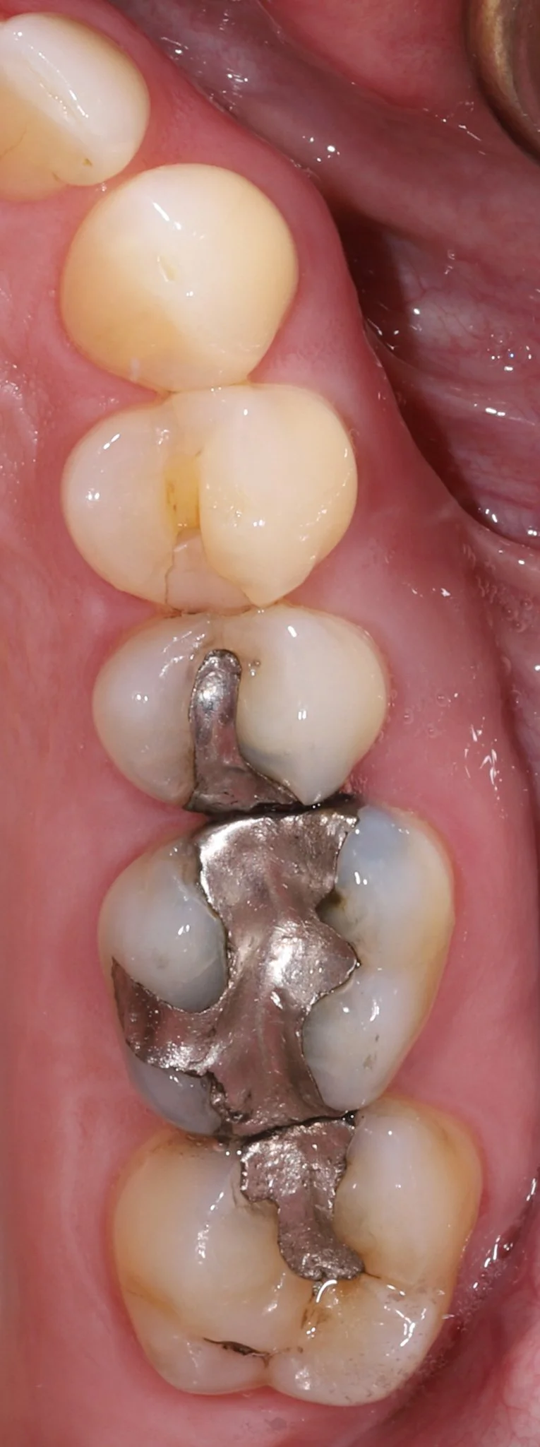 Close-up of teeth showing dental amalgam fillings on molars.