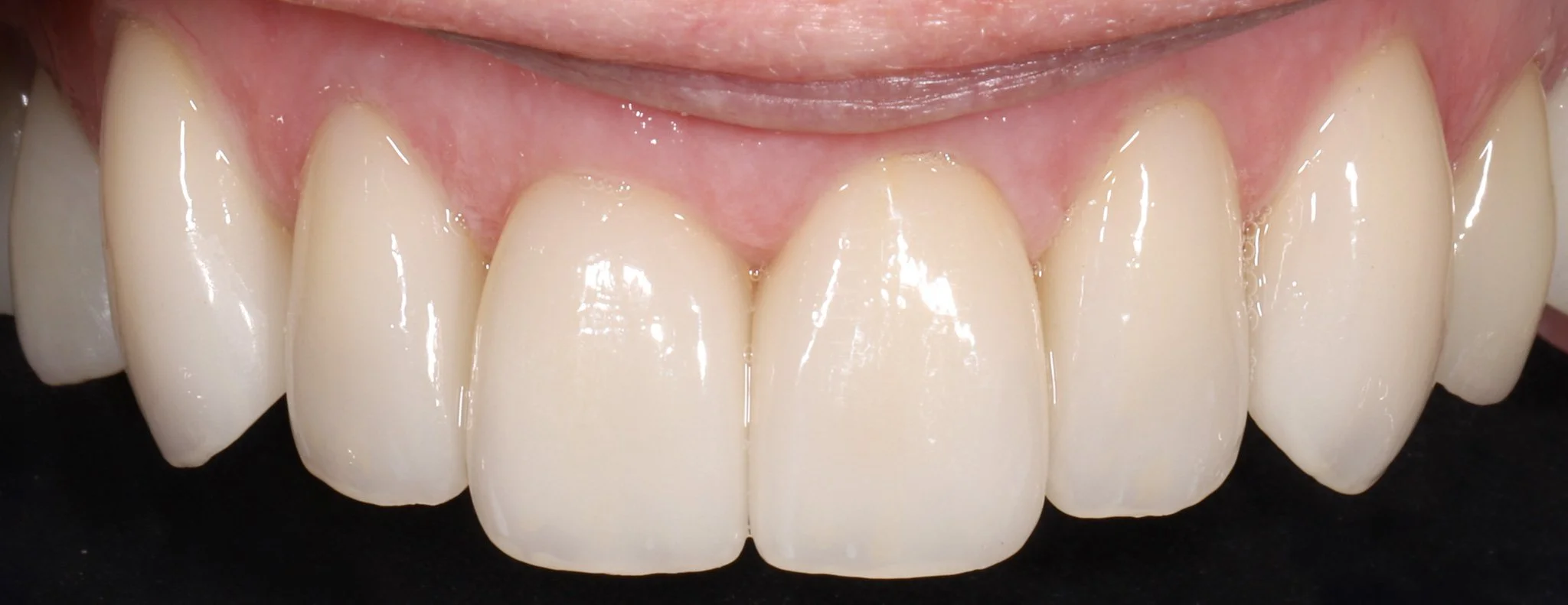 Close-up of a person's upper front teeth, showing dental veneers or crowns.