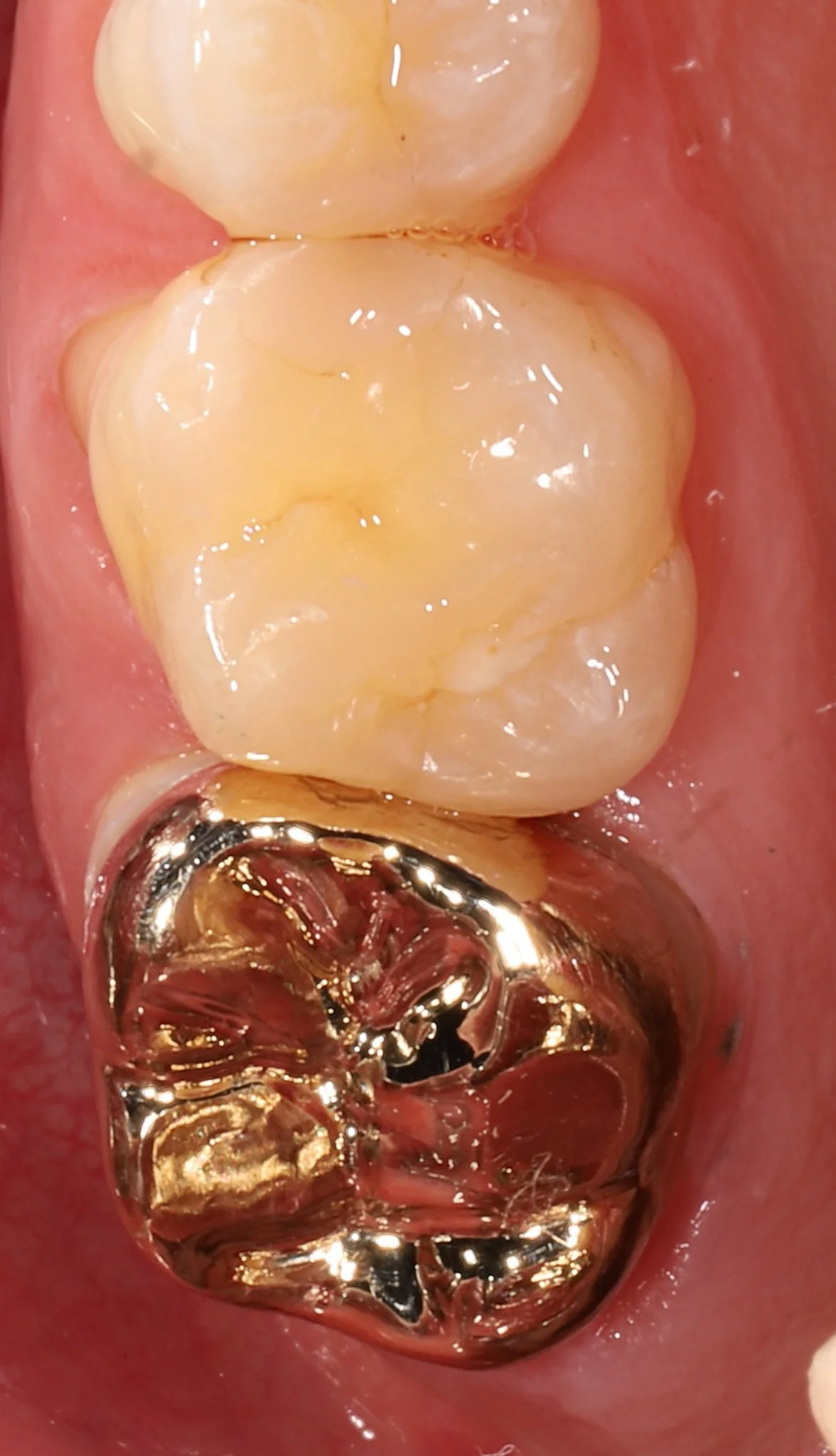 Close-up of the lower molars in a person's mouth, showing a gold dental filling on the bottom molar and the other teeth are natural and clean.