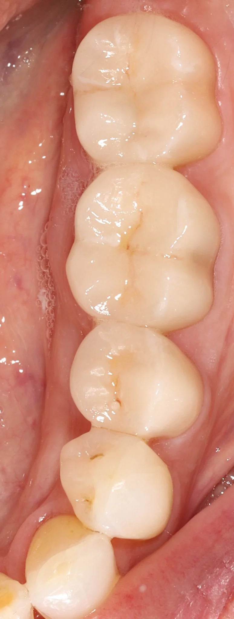 Close-up view of molar teeth in a person's mouth showing restorations with bonded porcelain with ideal fit and appearance.