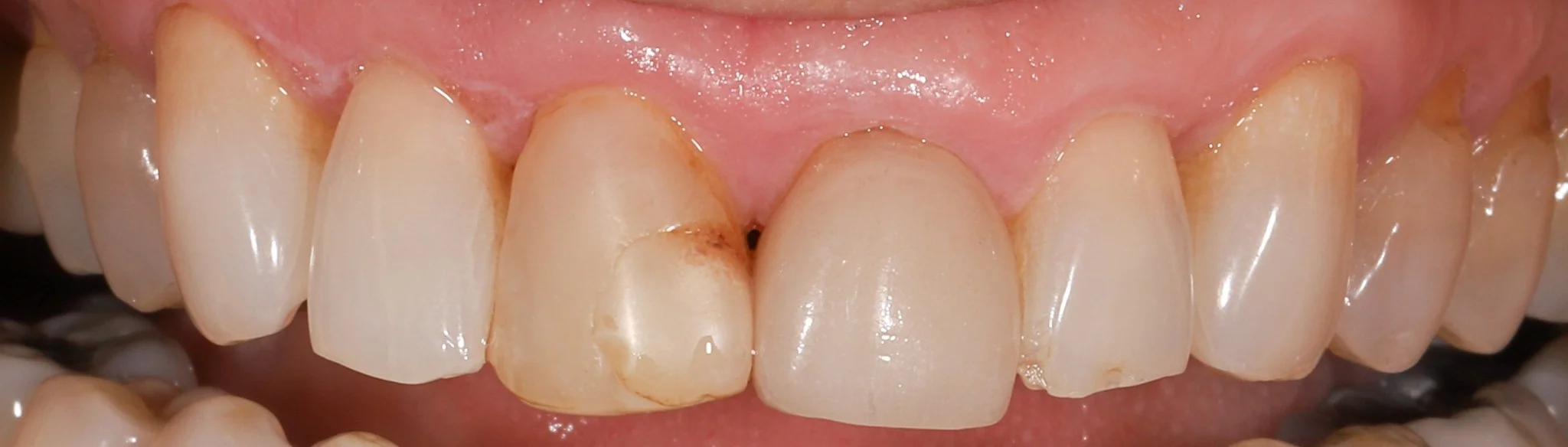 Close-up of front teeth showing uneven gum heights, old crowns and fillings that do not blend properly.  Prior to restorative treatment.