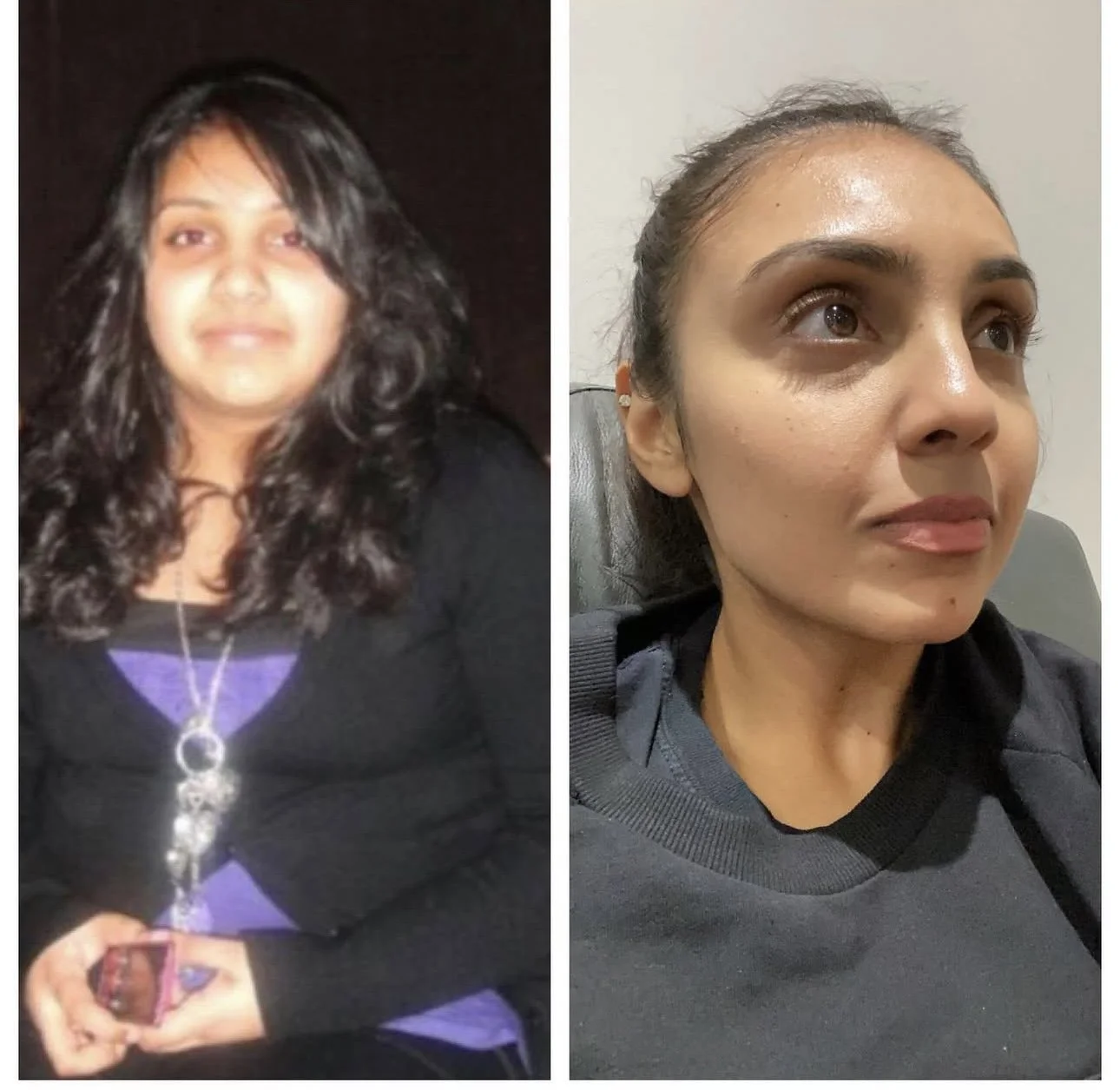 Side-by-side photos of a woman before and after a cosmetic procedure, with the first showing her with long, dark, curly hair in a dark background, and the second showing her with minimal makeup and her hair pulled back in a neutral setting.