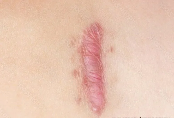 Skin cancer surgery, melanoma surgery, basal cell cancer surgery, squamous cell cancer surgery, minor procedure surgery, cyst removal, xanthoma removal
Carpal tunnel surgery, trigger finger surgery, finger surgery, hand fracture surgery, dupuytren