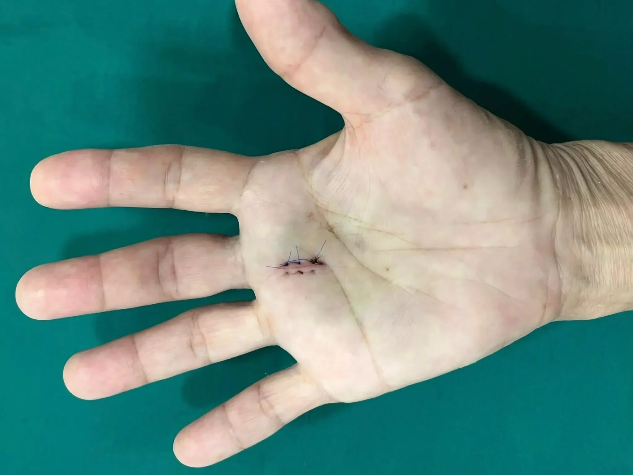 Skin cancer surgery, melanoma surgery, basal cell cancer surgery, squamous cell cancer surgery, minor procedure surgery, cyst removal, xanthoma removal
Carpal tunnel surgery, trigger finger surgery, finger surgery, hand fracture surgery, dupuytren