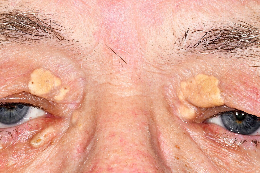 Skin cancer surgery, melanoma surgery, basal cell cancer surgery, squamous cell cancer surgery, minor procedure surgery, cyst removal, xanthoma removal
Carpal tunnel surgery, trigger finger surgery, finger surgery, hand fracture surgery, dupuytren