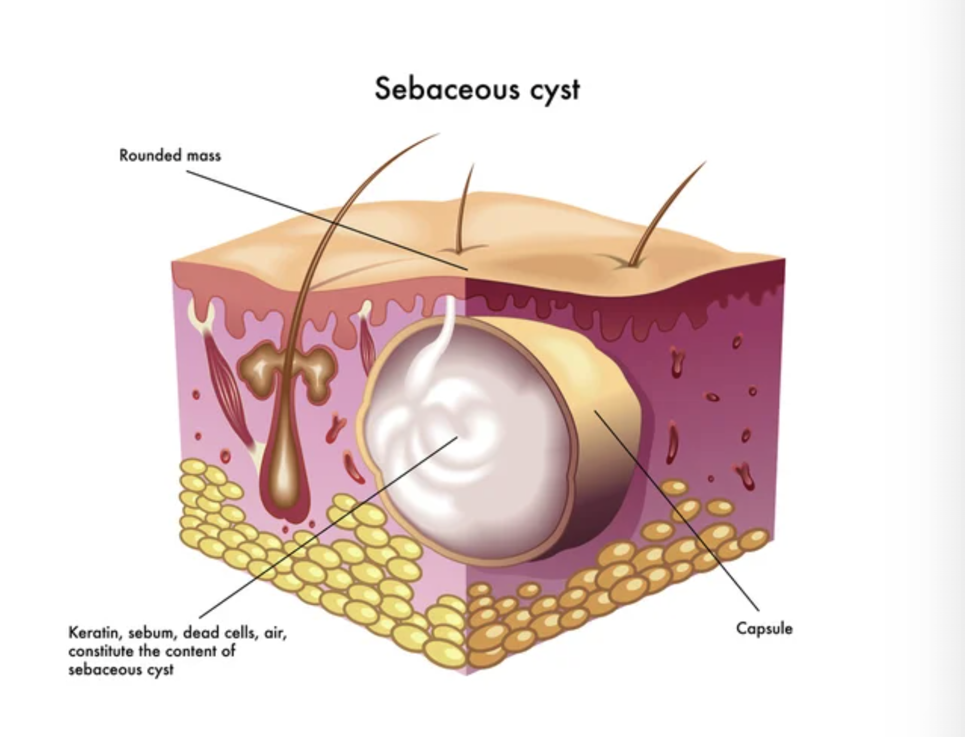 Skin cancer surgery, melanoma surgery, basal cell cancer surgery, squamous cell cancer surgery, minor procedure surgery, cyst removal, xanthoma removal
Carpal tunnel surgery, trigger finger surgery, finger surgery, hand fracture surgery, dupuytren