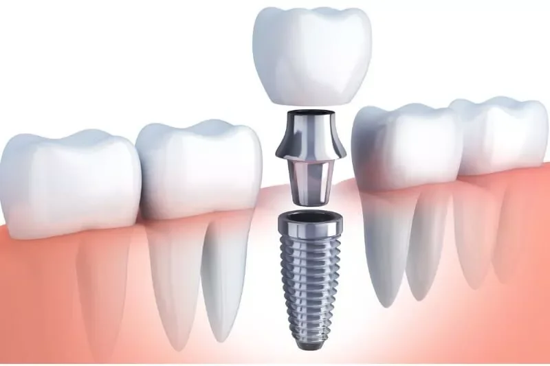 Image of a dental implant going into the gums next to real teeth