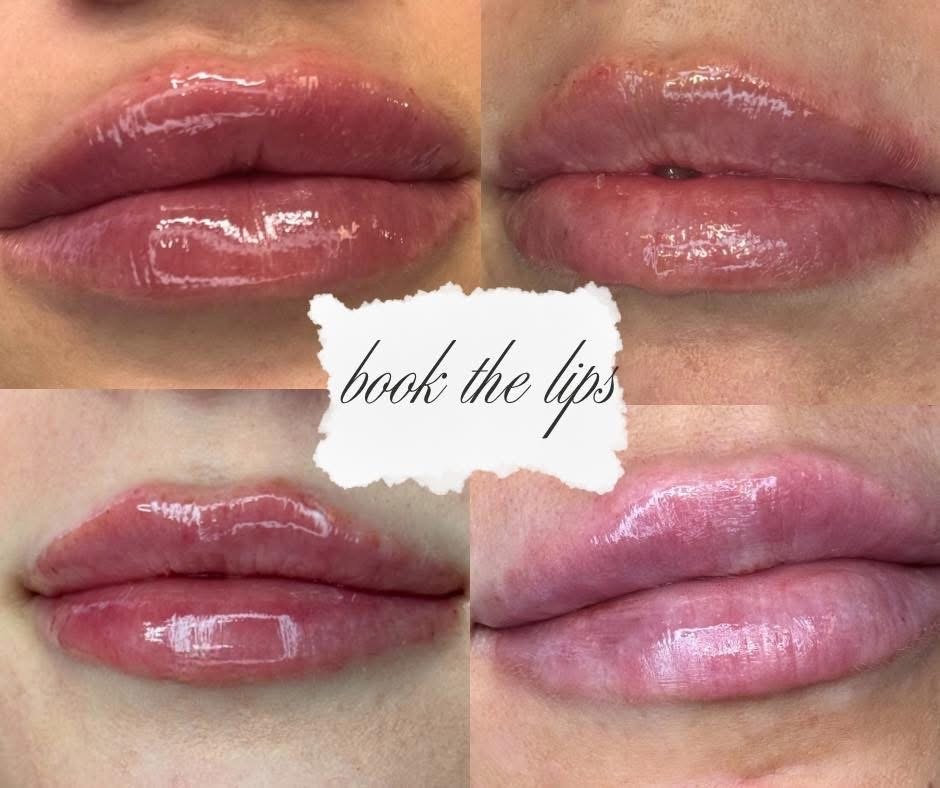 Lip Filler