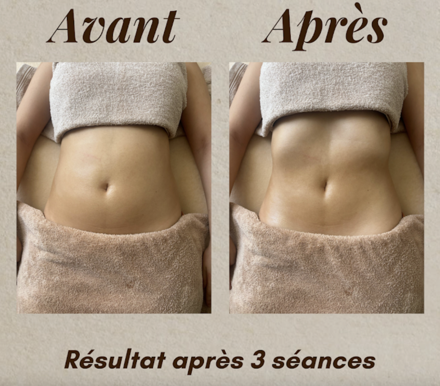 Photos avant/après drainage lymphatique à port de bouc, martigues, marseille