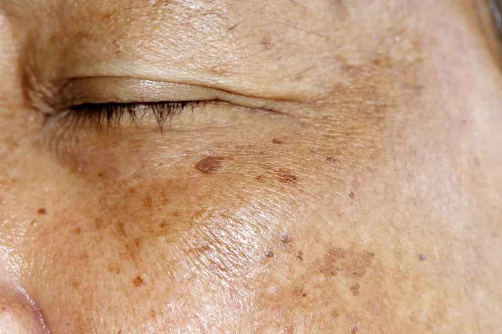 Close-up of a person's face with visible freckles, age spots, and skin imperfections.