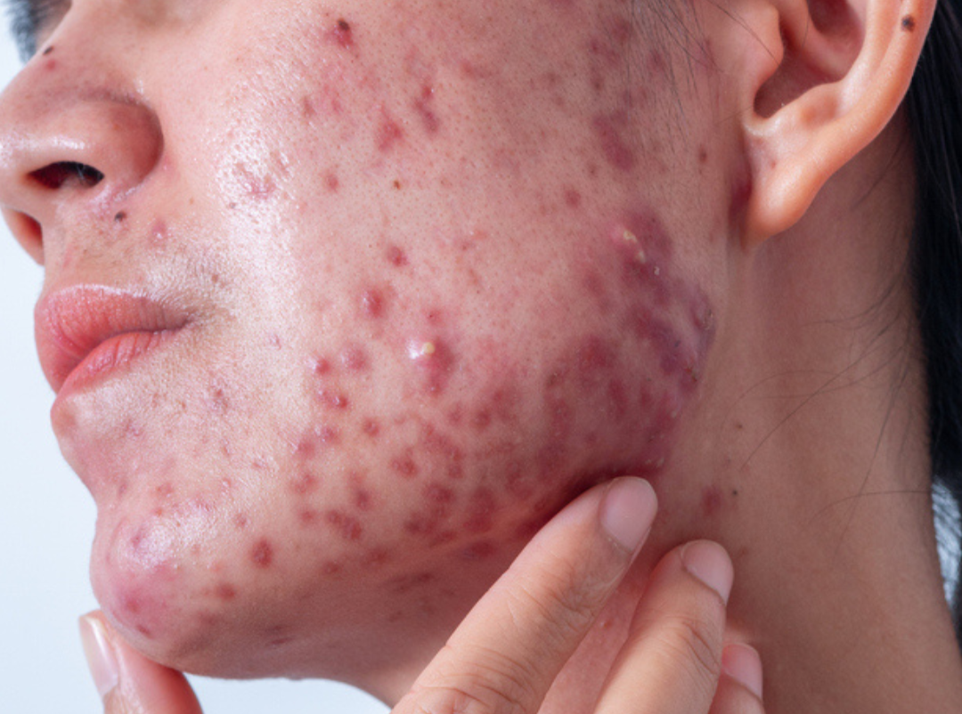 Close-up of a person's face showing severe acne with numerous red pimples and bumps on the cheek and jawline.