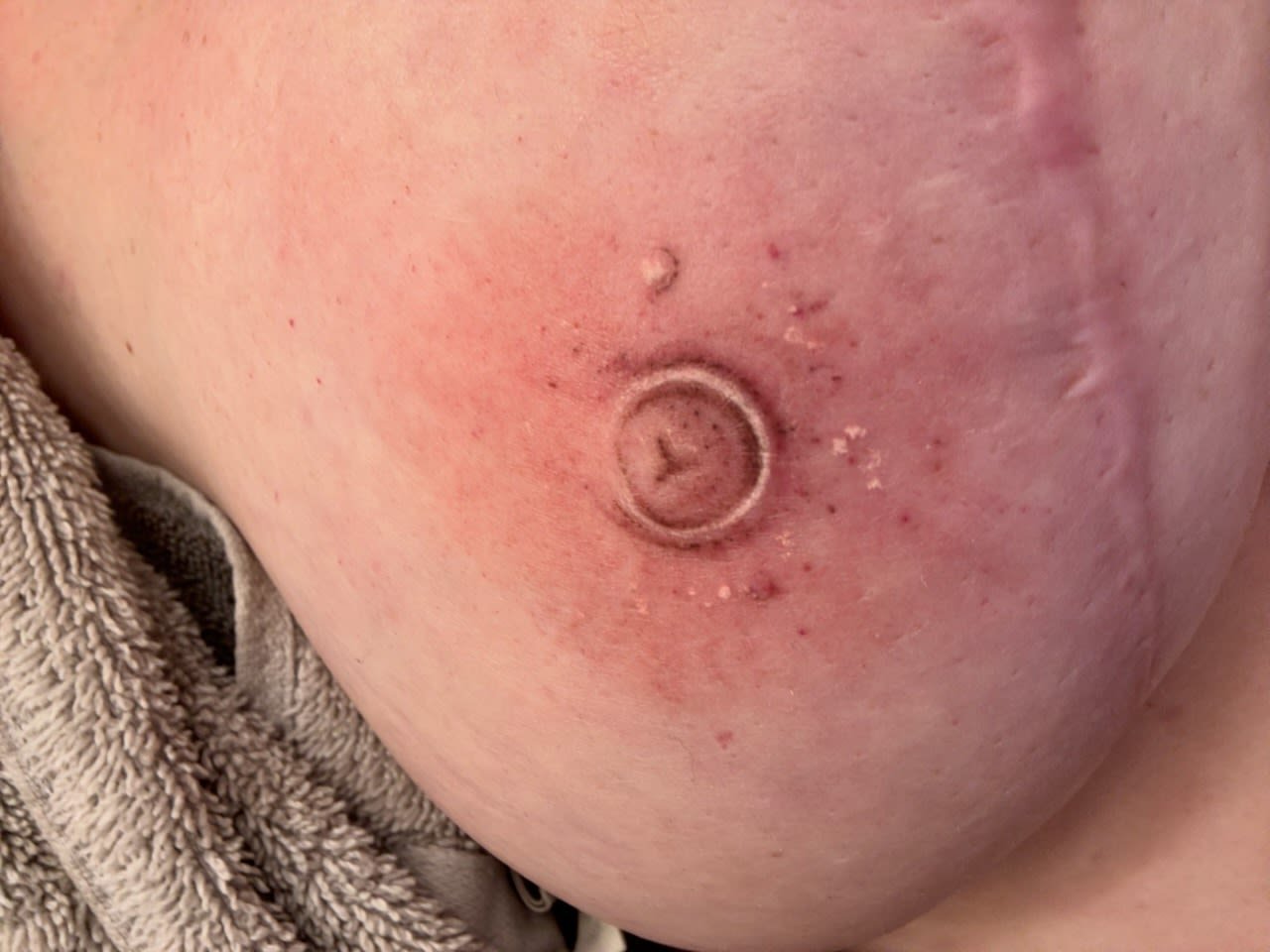 Close-up of a person's skin showing a small, circular scar with a raised center and surrounding redness.